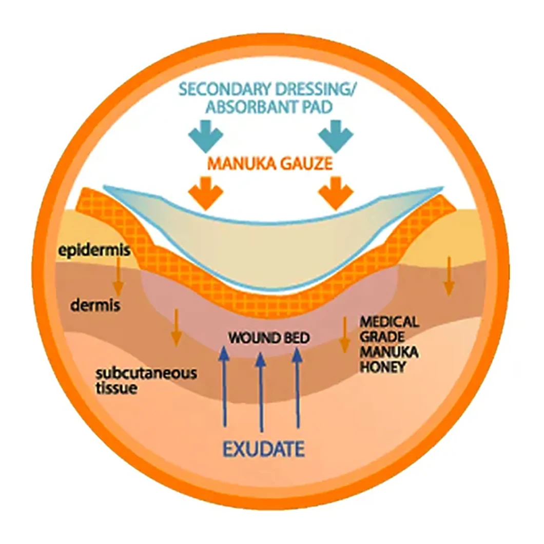 Hot Sale Manuka Honey Medical Gauze Wound Dressing